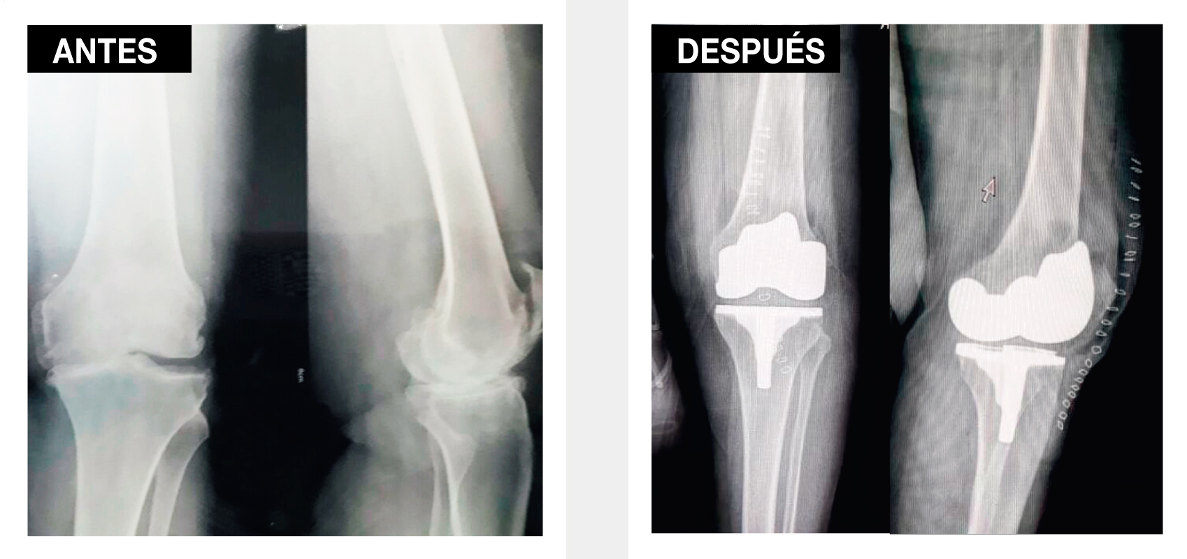 Gonartrosis O Artrosis De Rodilla Dr Trujillo Amador