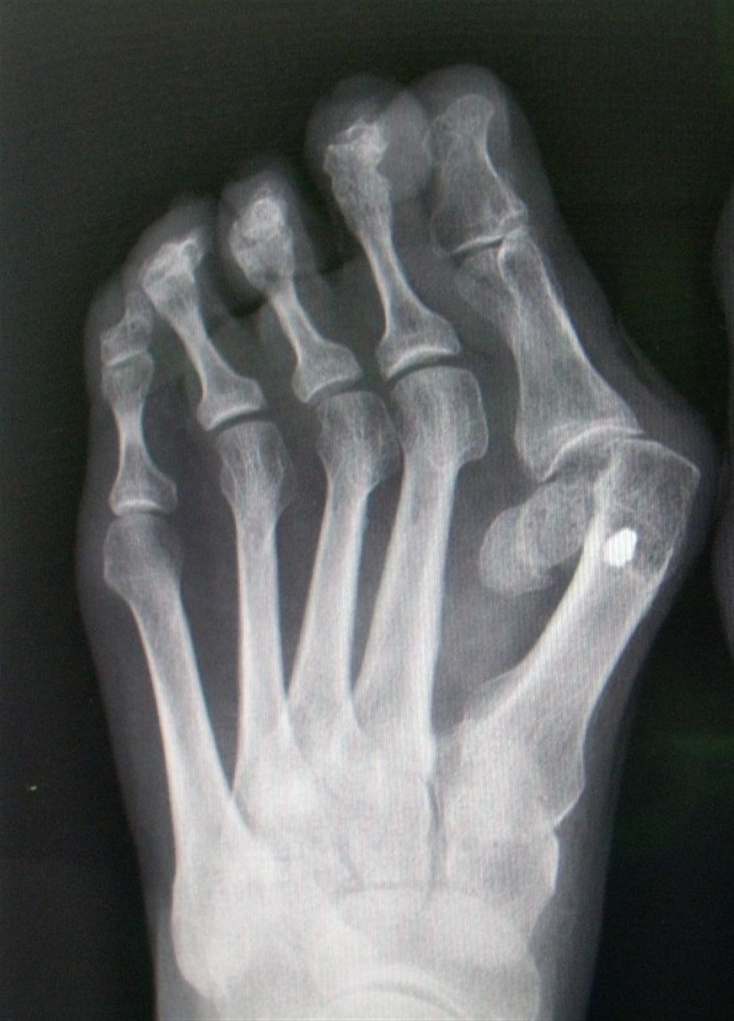 Деформация пальцев стопы мкб. Вальгусная деформация 1 пальца рентген. Халлюкс вальгус стопы рентген. Степени вальгусной деформации 1 пальца стопы рентген.